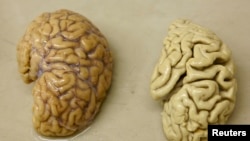 Hoton kwakwalwa mai lafiya kenan a hagu; kwakwalwa mai cutar Alzheimer kuma a dama.