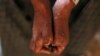 FILE - A patient shows the effects of leprosy on his hands in Myanchaung Leprosy Hospice, Halegu township, Yangon Division, Jan. 21, 2014. Southern Malawi has seen a resurgence of leprosy, which was believed to have been stamped out in the country in 1970.